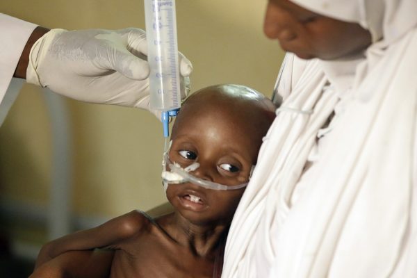 ילד מוכה רעב מטופל בניגריה (צילום: סוכנות AP).