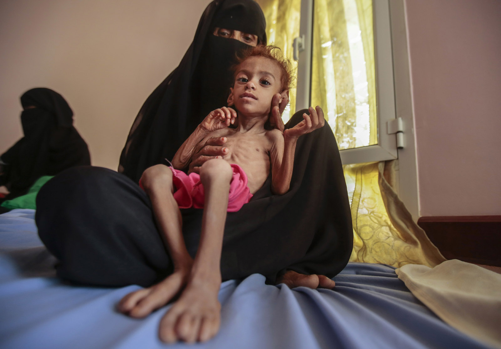אמא וילדה המצוי בתת תזונה בעקבות מלחמת האזרחים. אוקטובר 2018 (AP Photo/Hani Mohammed, File)