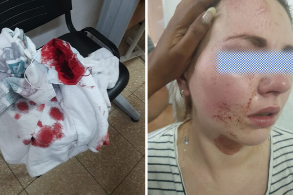 האחות שהותקפה במרכז הרפואי לבריאות הנפש באר יעקב, 14 במאי 2020 (צילום: צוות סיעוד באר יעקב)