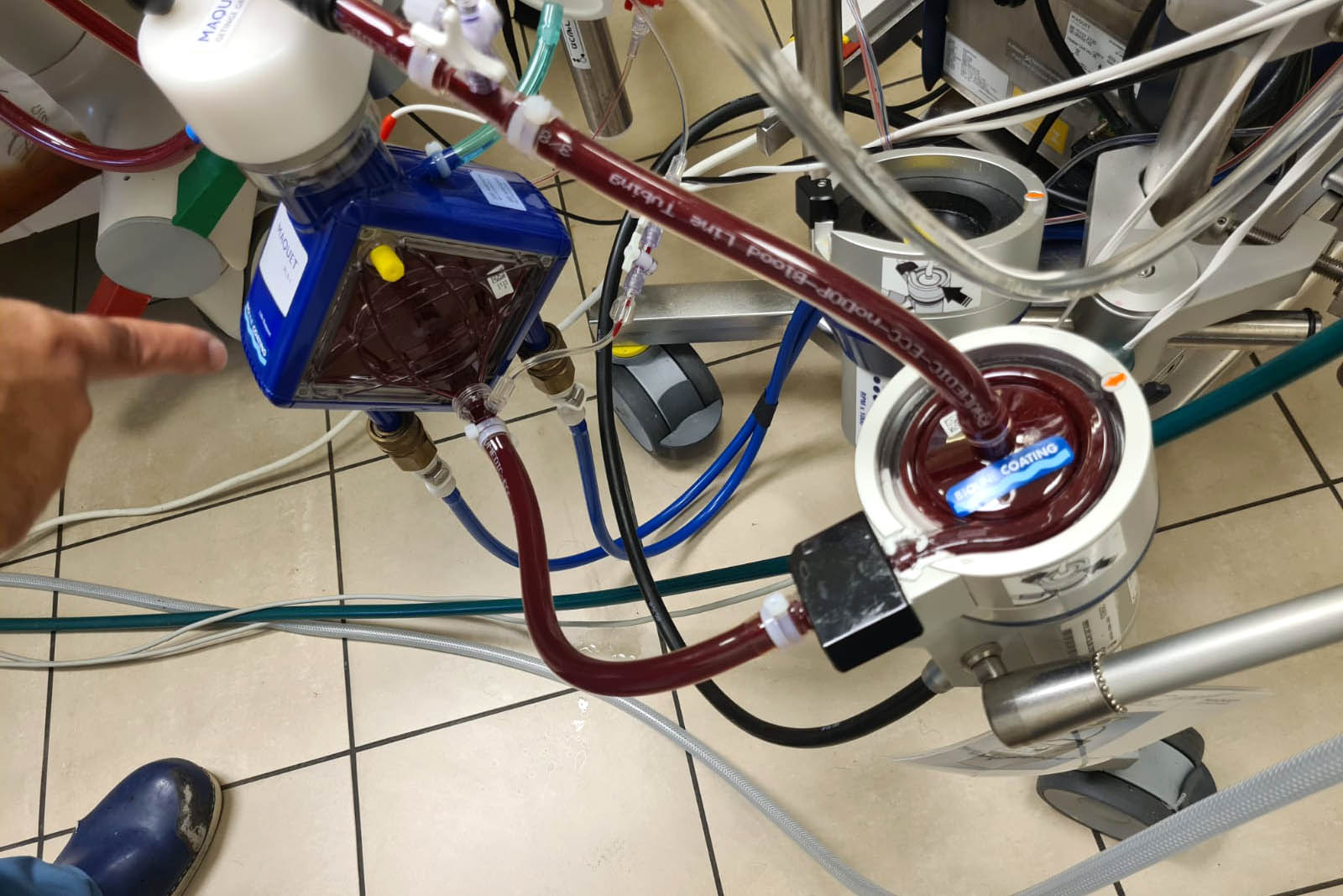 جهاز إكمو قيد الاستخدام: قلب صناعي من الجهة اليمنى، رئة صناعية من الجهة اليسرى (تصوير: دافنا إيزبروخ)