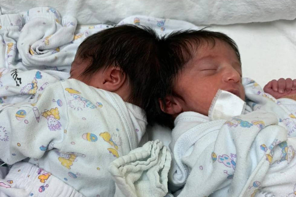 התאומות שנולדו כשהן מחוברות בגולגולת, לפני ניתוח ההפרדה (צילום: בית חולים סורוקה)