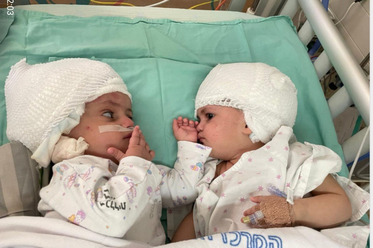 התאומות שנולדו כשהן מחוברות בגולגולת, לאחר ניתוח ההפרדה (צילום: בית חולים סורוקה)
