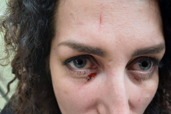 תקיפה שלישית ב-48 שעות: אחות הותקפה על ידי מטופלת בבית החולים אברבנאל