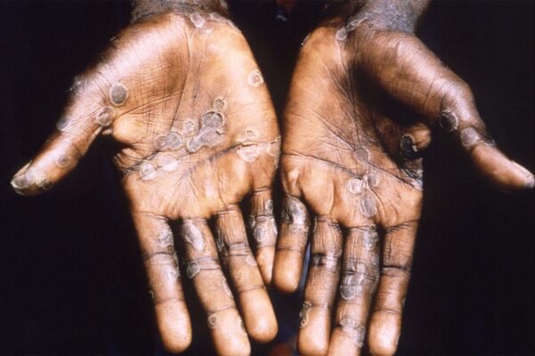 ידיים של חולה באבעבועות הקוף ברפובליקה הדמוקרטית של קונגו, 1997 (צילום ארכיון:
Brian W.J. Mahy/CDC/Handout via REUTERS.)