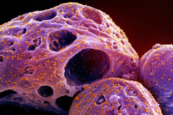 הדמיה של תאים נגועים בזן האומיקרון של נגיף הקורונה, שפרסם המכון הלאומי של ארה"ב לאלרגיה ולמחלות זיהומיות. התאים, שבודדו מדגימה של חולה קורונה, נצבעו בסגול, והנגיף נצבע בכתום. הצילום הופק במתקן המחקר המשולב של הארגון בפורט מדריק, מרילנד (NIAID/NIH via AP)